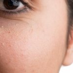 5 best ways to get rid of milia on face