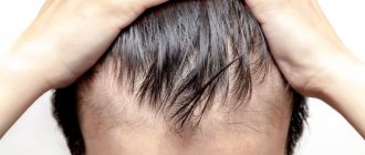 Alopecia in men: causes and treatment of male pattern baldness