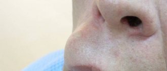 Atheroma above the lip