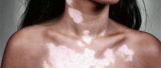 White spots on a girl&#39;s skin
