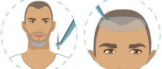 Борода в трансплантологии волос