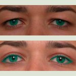 What is upper eyelid blepharoplasty and how much does it cost?