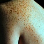 Why do you need freckles all over your body and is it possible to get rid of them?