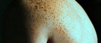 Why do you need freckles all over your body and is it possible to get rid of them?