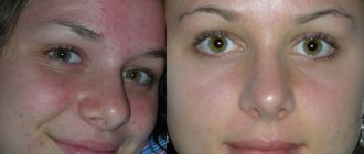 Before and after dermabrasion