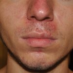 Effectively getting rid of acne under the nose