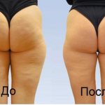 The effectiveness of anti-cellulite massage