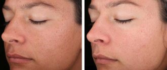 Erbium laser (before and after photos)