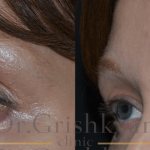 photo before and after lipofilling of the upper eyelid photo