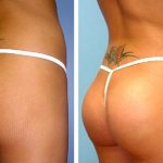 Photos before and after implants in the buttocks