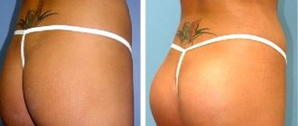 Photos before and after implants in the buttocks