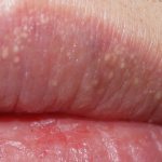 Fordyce granules on the lips. Photos, causes, symptoms, treatment, how to get rid of 