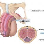 Injection into the penis - the cause of oleogranuloma of the penis