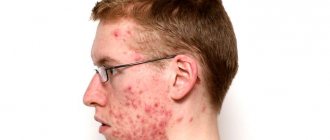 The true causes of acne after peeling