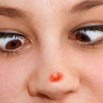 how to get rid of pimples on your nose how to quickly get rid of a pimple on your nose