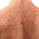 Keratosis of the skin. Photos of adults on the face and body. Causes, stages, symptoms and treatment 