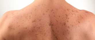 Keratosis of the skin. Photos of adults on the face and body. Causes, stages, symptoms and treatment 