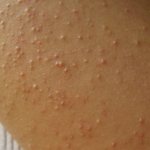 Keratosis - symptoms and treatment, photos and videos.