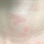 Red itchy spots on the neck occur as a result of allergies.