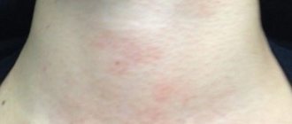 Red itchy spots on the neck occur as a result of allergies.