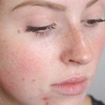 red spots on the face