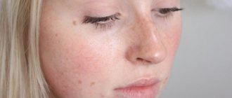 red spots on the face