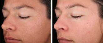 Laser facial cleansing has a beneficial effect on facial skin.