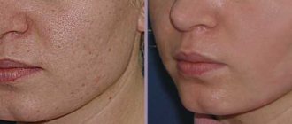 Laser peeling before and after