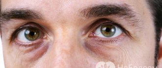 Bags under the eyes: the main causes of their appearance