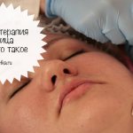 Facial mesotherapy what is it?
