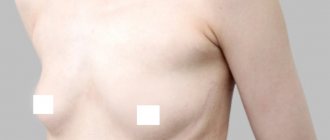 Micromastia is a pathology of breast development