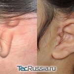 microtia – before and after photos