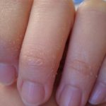 The skin on the tips of your fingers will peel off. Causes of peeling hands 