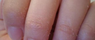 The skin on the tips of your fingers will peel off. Causes of peeling hands 