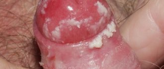 swelling and redness of the penis due to candidiasis