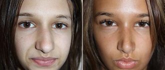 Thirteen-year-old patient before and after rhinoplasty