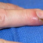 panaritium - a purulent skin disease