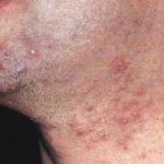 Papules and pustules: what do they look like?