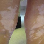 Why do white spots appear on legs?