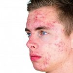Teenage acne in a young man