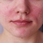 Redness on the face, near the nose, on the cheeks. How to remove irritation, allergies, itching 