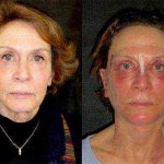 consequences of a facelift