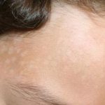 Causes, treatment of pityriasis versicolor on the face