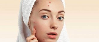 Problematic facial skin with acne