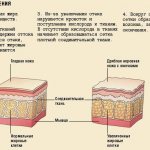 The process of cellulite formation