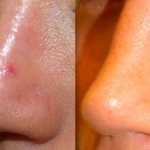 Spot on the nose: red, pigmented, peeling at the tip of the nose