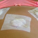 Wounds after laparoscopy are covered with sterile dressings