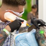 Today tattoos are removed with laser