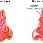 Septoplasty and vasotomy