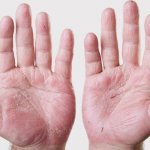 peeling skin on the palms causes, treatment and prevention